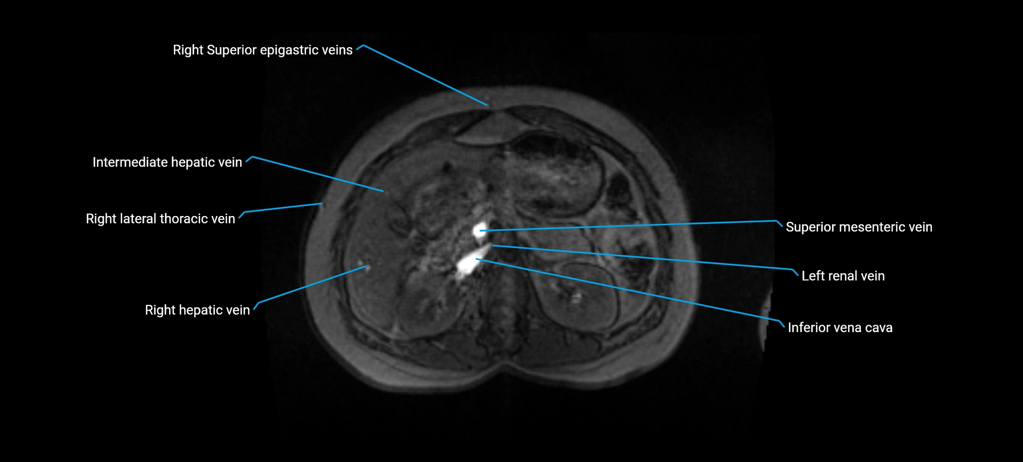 MRV abdomen pelvis & lower limb axial cross sectional anatomy labelled MRI image 57 (1).webp